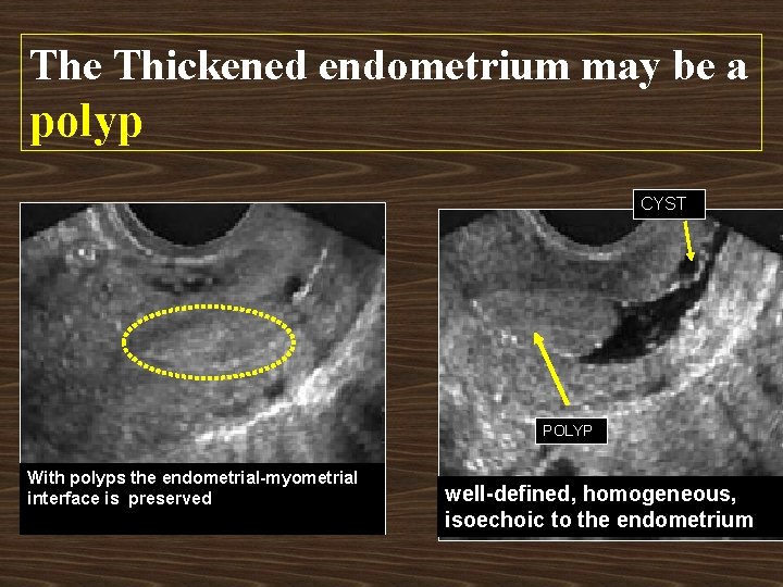The Thickened endometrium may be a polyp CYST POLYP With polyps the endometrial-myometrial interface