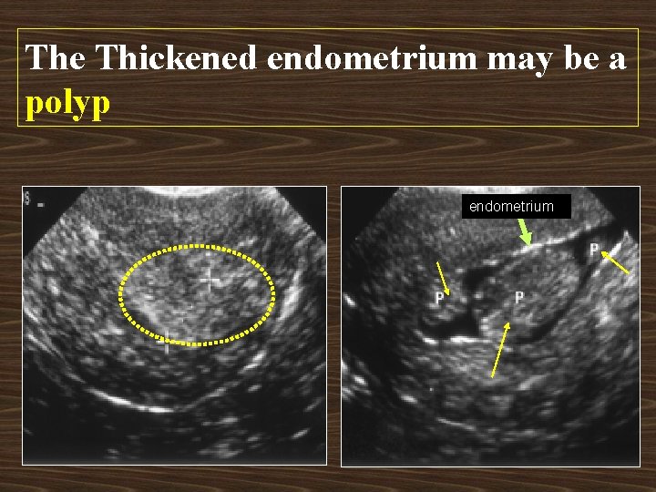 The Thickened endometrium may be a polyp endometrium 