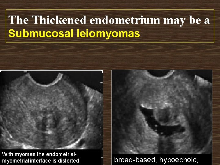 The Thickened endometrium may be a Submucosal leiomyomas With myomas the endometrialmyometrial interface is