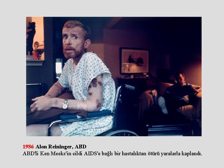 1986 Alon Reininger, ABD'li Ken Meeks'in cildi AIDS'e bağlı bir hastalıktan ötürü yaralarla kaplandı.