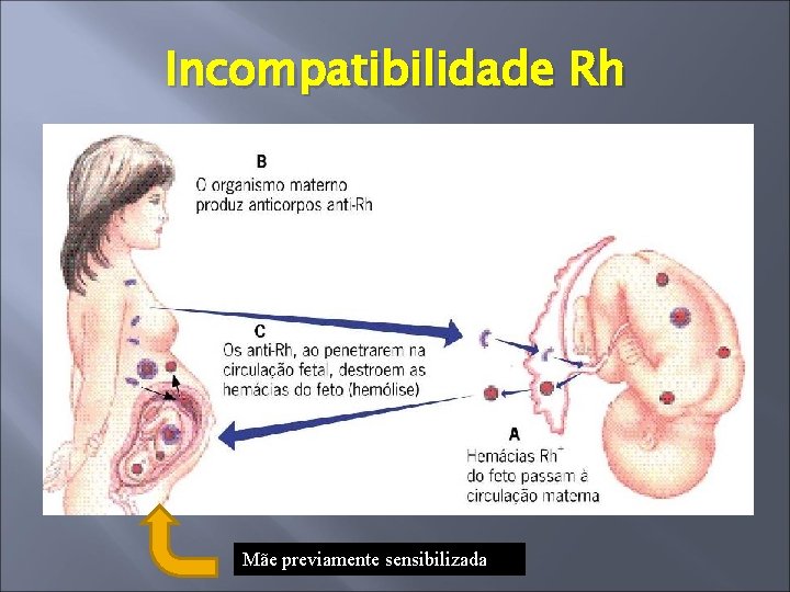 Incompatibilidade Rh Mãe previamente sensibilizada 