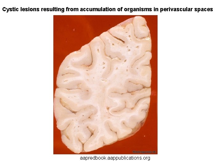 Cystic lesions resulting from accumulation of organisms in perivascular spaces aapredbook. aappublications. org 