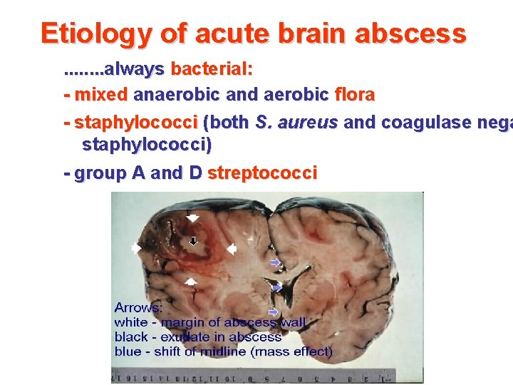 Etiology of acute brain abscess . . . . always bacterial: - mixed anaerobic