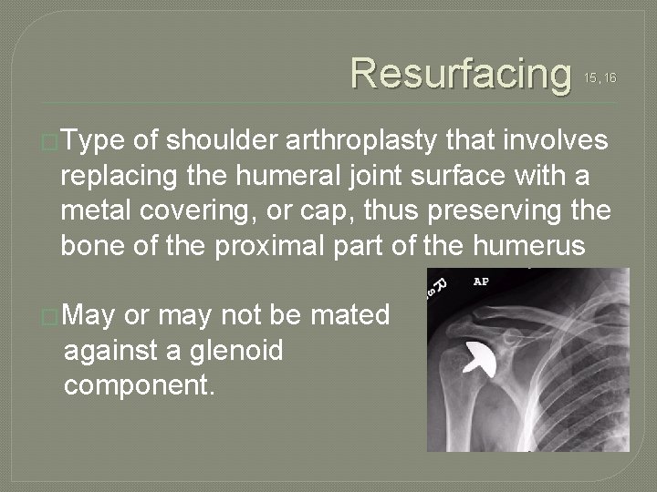 Resurfacing �Type 15, 16 of shoulder arthroplasty that involves replacing the humeral joint surface