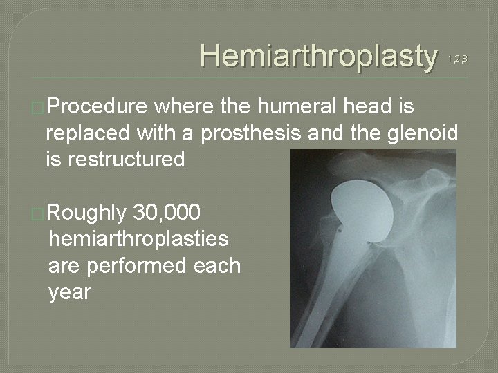 Hemiarthroplasty �Procedure 1, 2, 8 where the humeral head is replaced with a prosthesis
