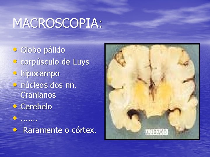 MACROSCOPIA: • Globo pálido • corpúsculo de Luys • hipocampo • núcleos dos nn.