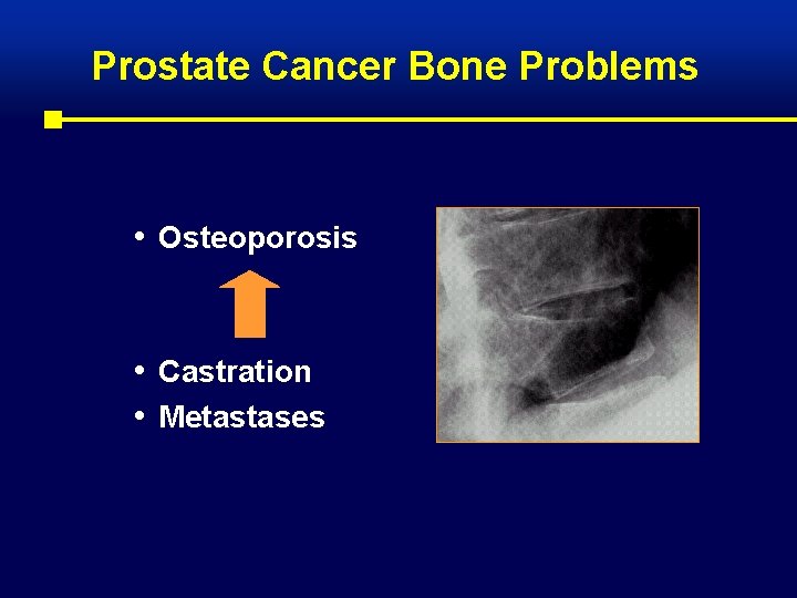 Prostate Cancer Bone Problems • Osteoporosis • Castration • Metastases 