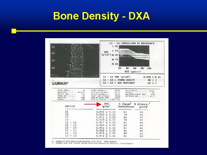 Bone Density - DXA 