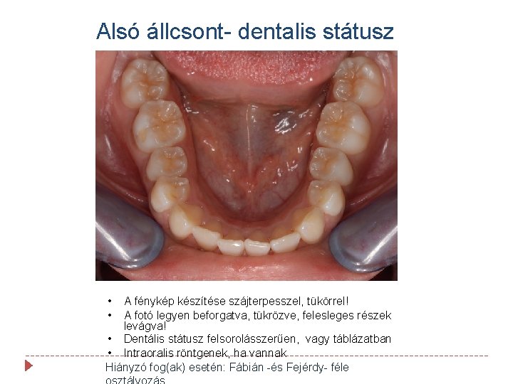 Alsó állcsont- dentalis státusz • • A fénykép készítése szájterpesszel, tükörrel! A fotó legyen