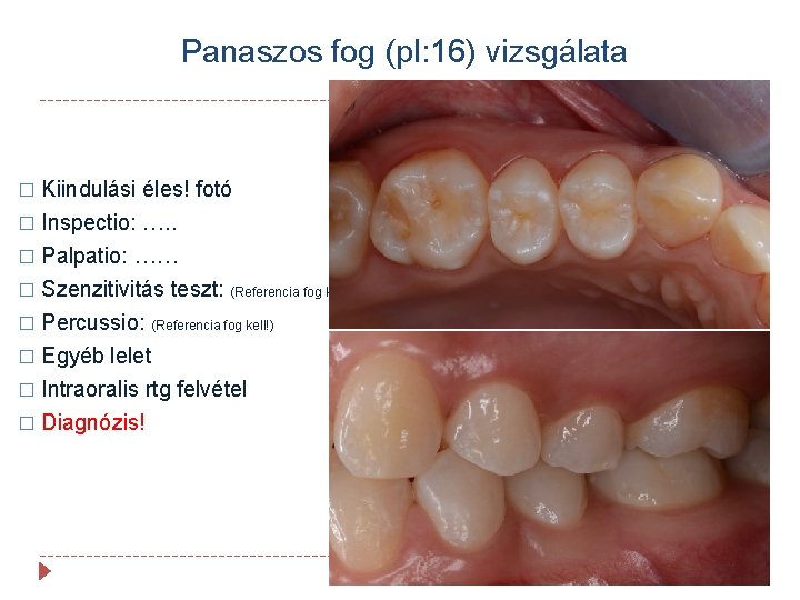 Panaszos fog (pl: 16) vizsgálata Kiindulási éles! fotó � Inspectio: …. . � Palpatio: