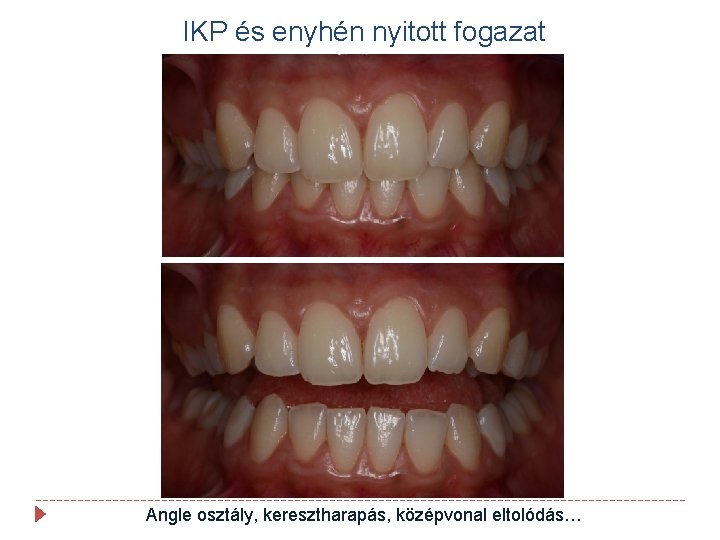 IKP és enyhén nyitott fogazat Angle osztály, keresztharapás, középvonal eltolódás… 