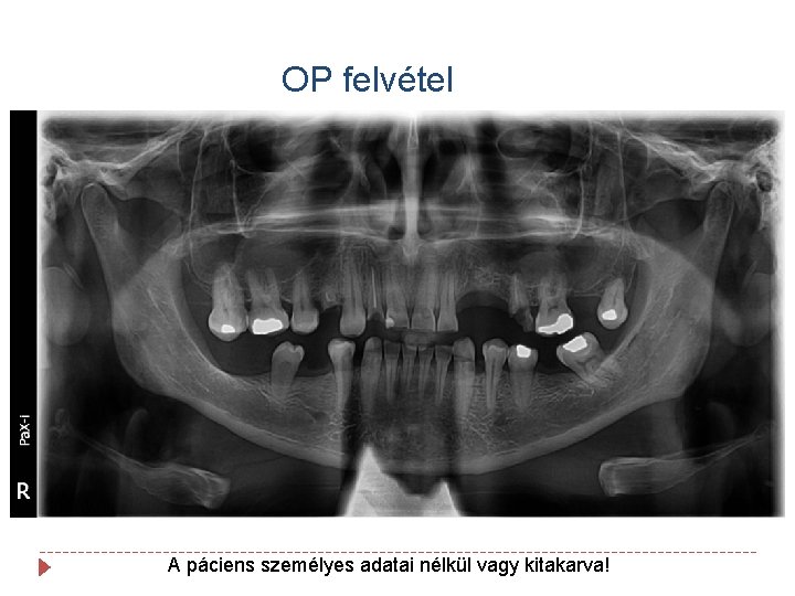 OP felvétel A páciens személyes adatai nélkül vagy kitakarva! 