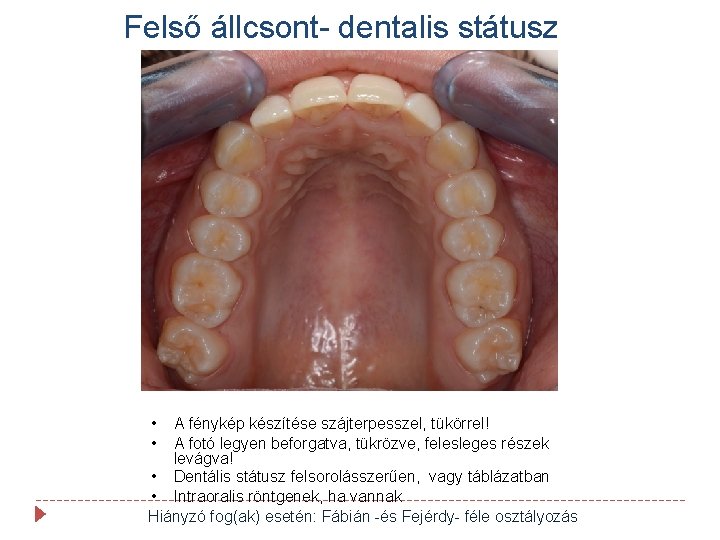Felső állcsont- dentalis státusz • • A fénykép készítése szájterpesszel, tükörrel! A fotó legyen