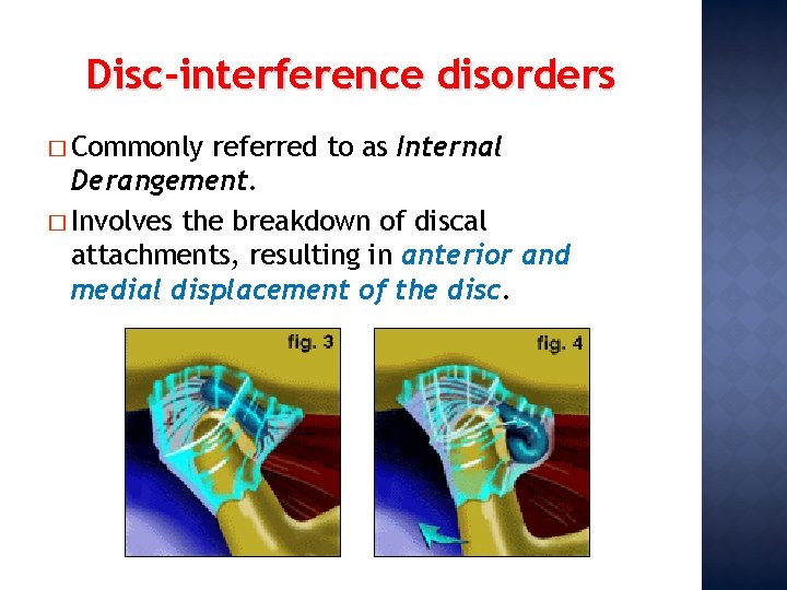Disc-interference disorders � Commonly referred to as Internal Derangement. � Involves the breakdown of
