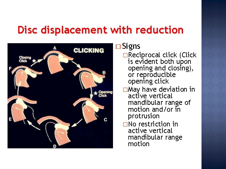 Disc displacement with reduction � Signs �Reciprocal click (Click is evident both upon opening