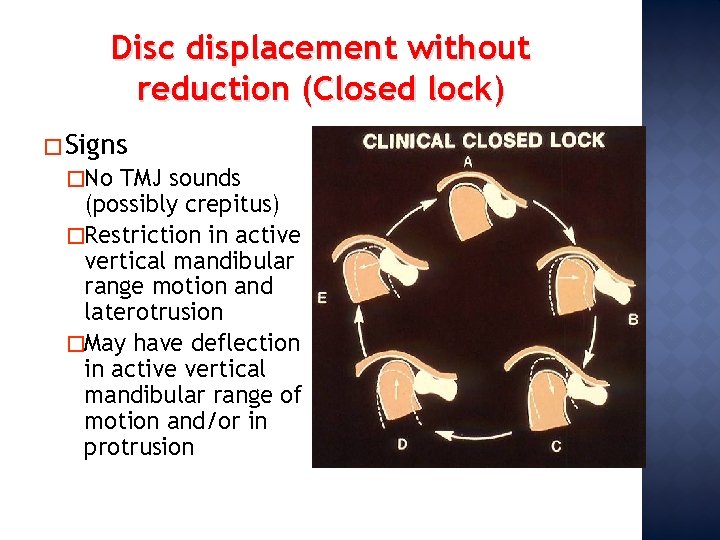 Disc displacement without reduction (Closed lock) � Signs �No TMJ sounds (possibly crepitus) �Restriction