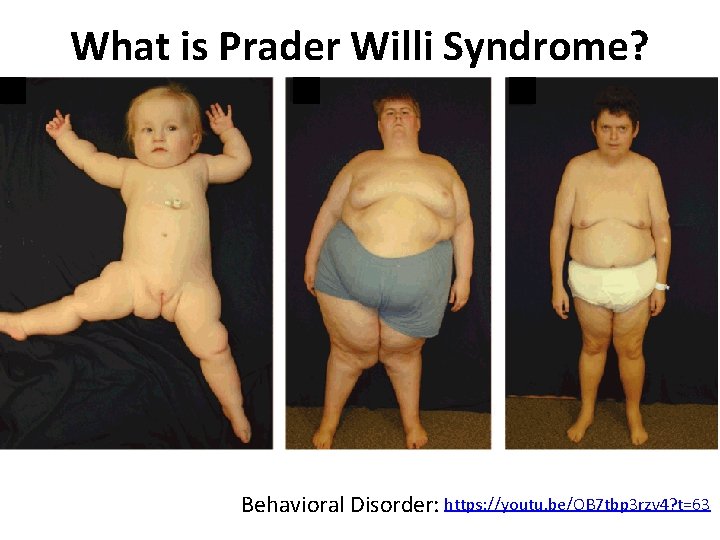 What is Prader Willi Syndrome? Behavioral Disorder: https: //youtu. be/OB 7 tbp 3 rzv