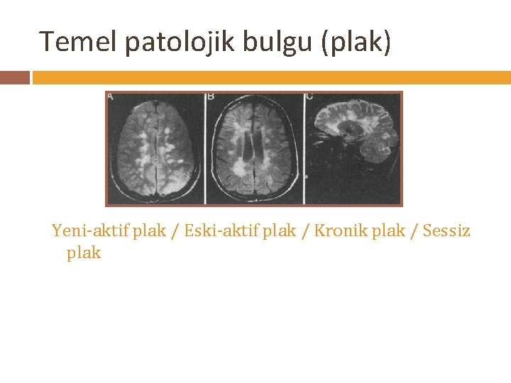 Temel patolojik bulgu (plak) Yeni-aktif plak / Eski-aktif plak / Kronik plak / Sessiz