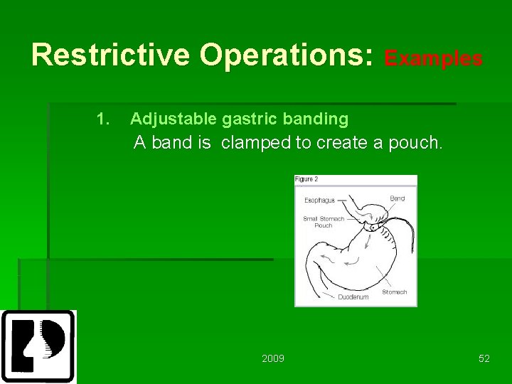 Restrictive Operations: Examples 1. Adjustable gastric banding A band is clamped to create a