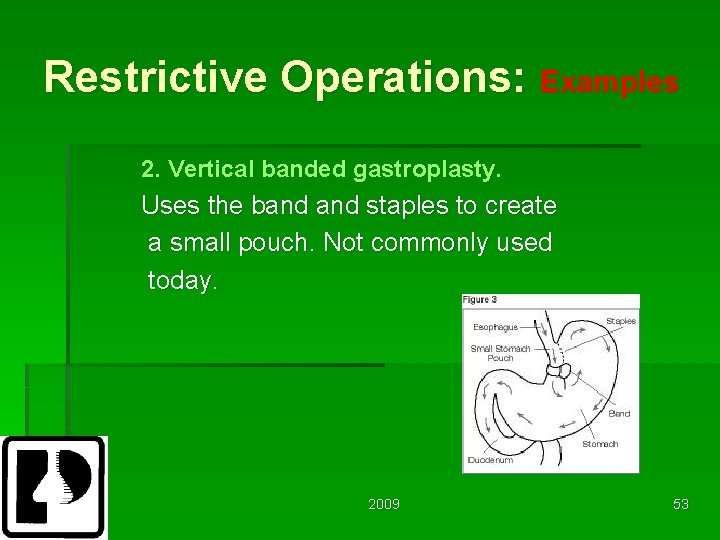 Restrictive Operations: Examples 2. Vertical banded gastroplasty. Uses the band staples to create a