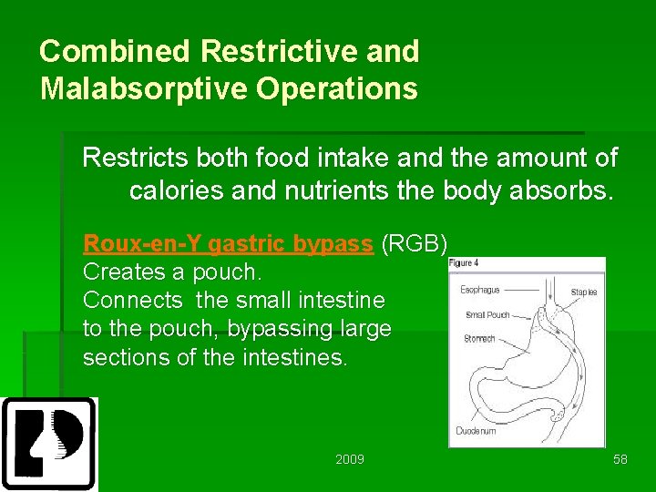 Combined Restrictive and Malabsorptive Operations Restricts both food intake and the amount of calories
