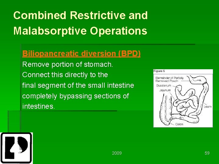 Combined Restrictive and Malabsorptive Operations Biliopancreatic diversion (BPD) Remove portion of stomach. Connect this