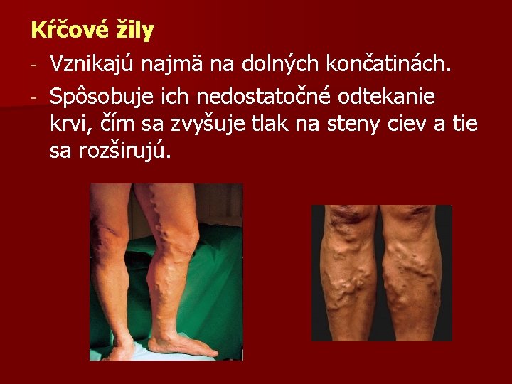 Kŕčové žily - Vznikajú najmä na dolných končatinách. - Spôsobuje ich nedostatočné odtekanie krvi,