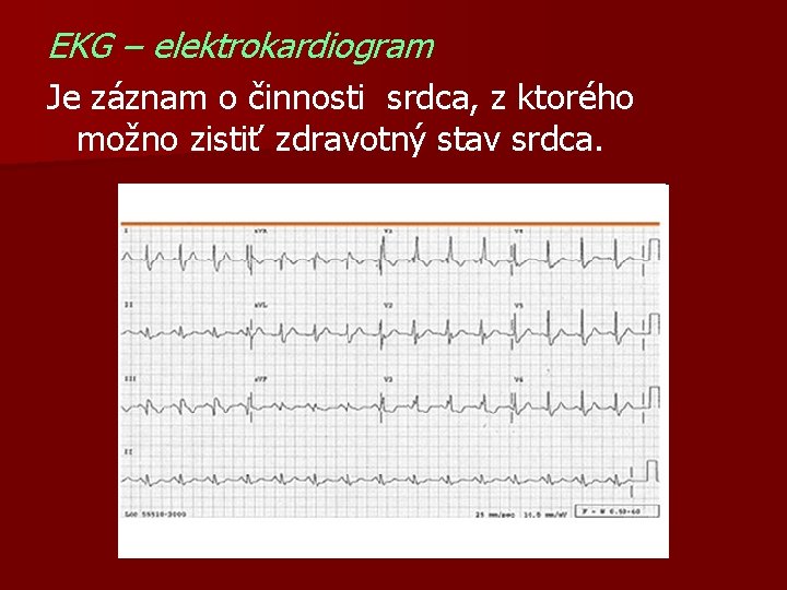 EKG – elektrokardiogram Je záznam o činnosti srdca, z ktorého možno zistiť zdravotný stav