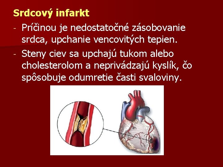 Srdcový infarkt - Príčinou je nedostatočné zásobovanie srdca, upchanie vencovitých tepien. - Steny ciev