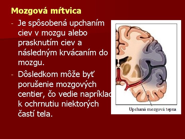 Mozgová mŕtvica - Je spôsobená upchaním ciev v mozgu alebo prasknutím ciev a následným