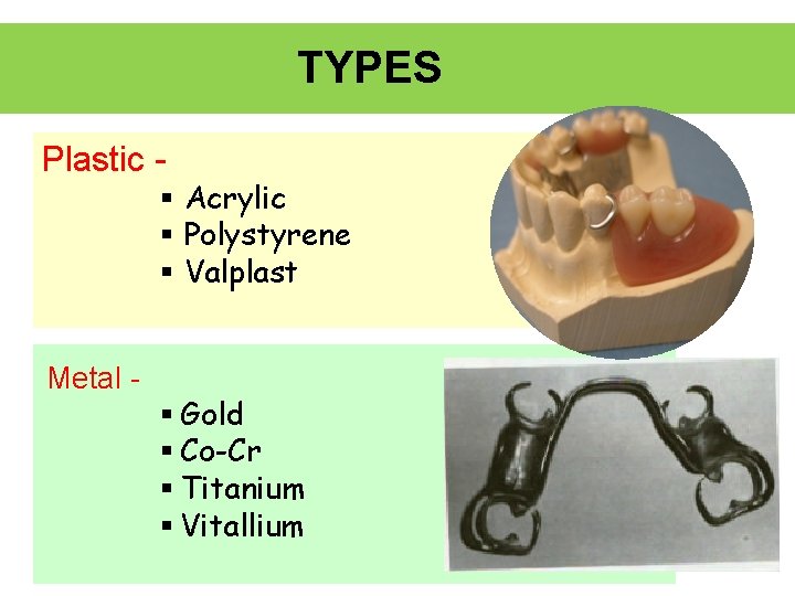 TYPES Plastic - § Acrylic § Polystyrene § Valplast Metal - § Gold §