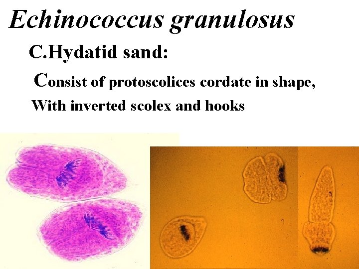 Echinococcus granulosus C. Hydatid sand: Consist of protoscolices cordate in shape, With inverted scolex