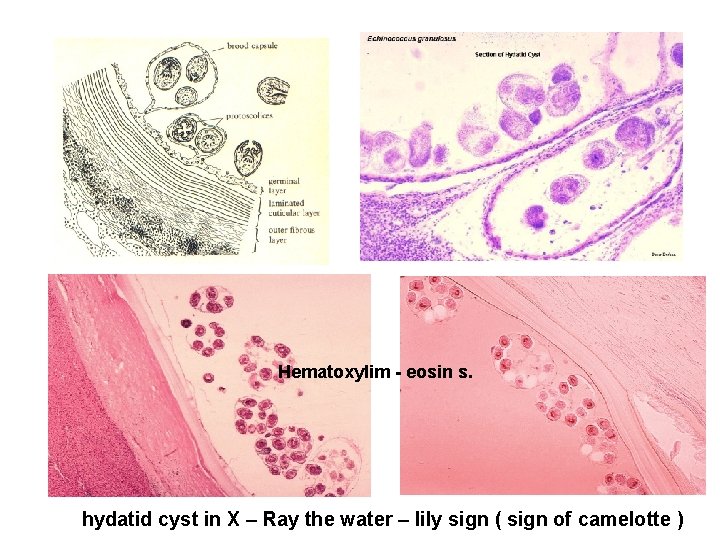 Hematoxylim - eosin s. hydatid cyst in X – Ray the water – lily