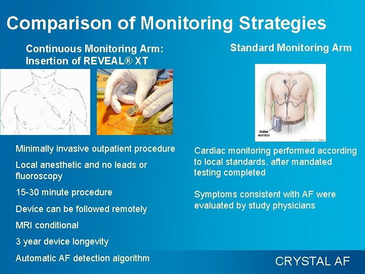 Comparison of Monitoring Strategies Continuous Monitoring Arm: Insertion of REVEAL® XT Minimally invasive outpatient