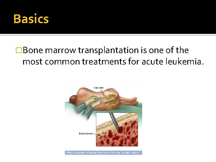 Basics �Bone marrow transplantation is one of the most common treatments for acute leukemia.