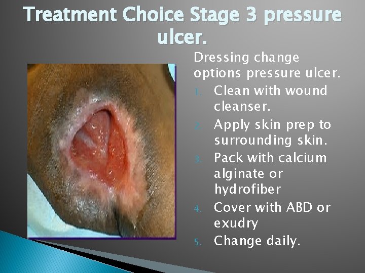 Treatment Choice Stage 3 pressure ulcer. Dressing change options pressure ulcer. 1. Clean with