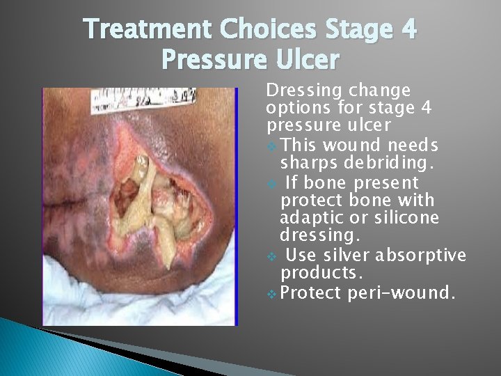 Treatment Choices Stage 4 Pressure Ulcer Dressing change options for stage 4 pressure ulcer