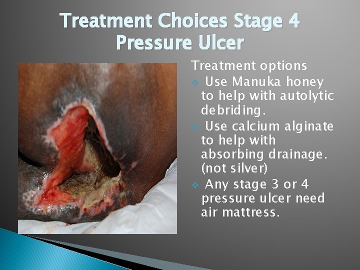 Treatment Choices Stage 4 Pressure Ulcer Treatment options v Use Manuka honey to help