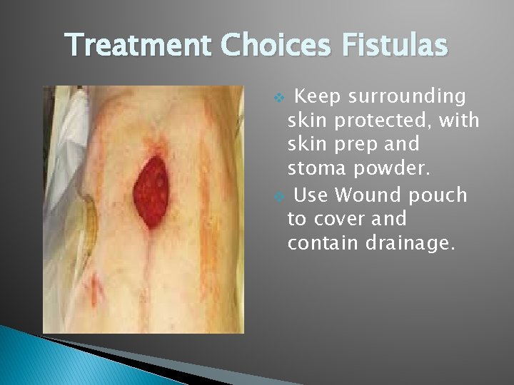 Treatment Choices Fistulas Keep surrounding skin protected, with skin prep and stoma powder. v