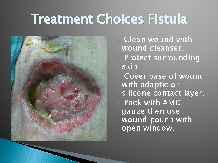 Treatment Choices Fistula Clean wound with wound cleanser. v Protect surrounding skin v Cover