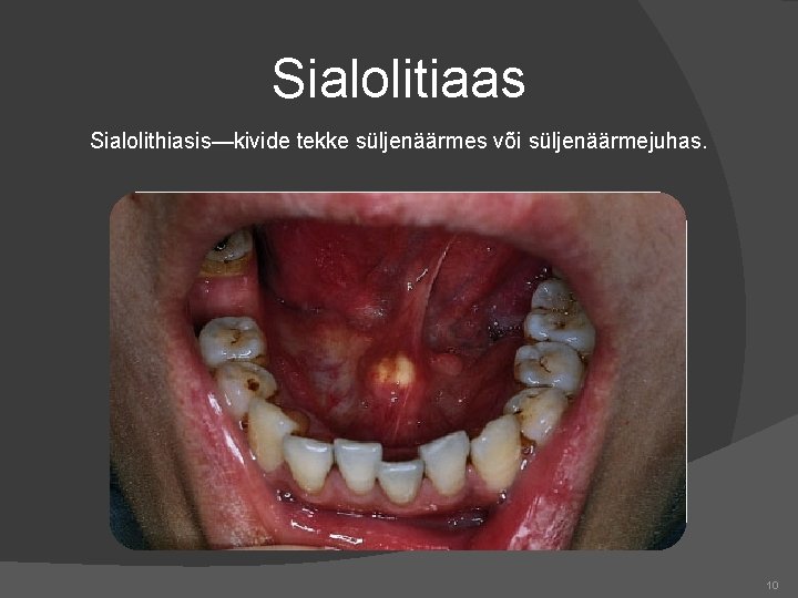 Sialolitiaas Sialolithiasis—kivide tekke süljenäärmes või süljenäärmejuhas. 10 