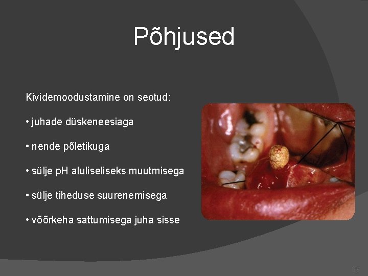 Põhjused Kividemoodustamine on seotud: • juhade düskeneesiaga • nende põletikuga • sülje p. H