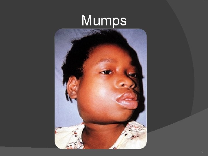 Mumps 7 