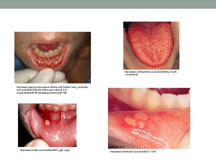 http: //www. oralhealthnet. co. uk/detail/3/dry-mouth -xerostomia/ http: //www. giovannimariagaeta. it/index. php? option=com_content&v iew=article&id=239: chemotherapy-induced-oralmucositis&catid=36: