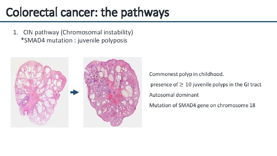 Colorectal cancer: the pathways 1. CIN pathway (Chromosomal instability) *SMAD 4 mutation : juvenile
