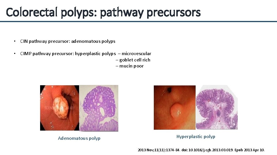 Colorectal polyps: pathway precursors • CIN pathway precursor: adenomatous polyps • CIMP pathway precursor: