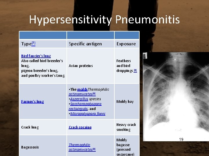 Hypersensitivity Pneumonitis Type[7] Specific antigen Bird fancier's lung Also called bird breeder's lung, Avian