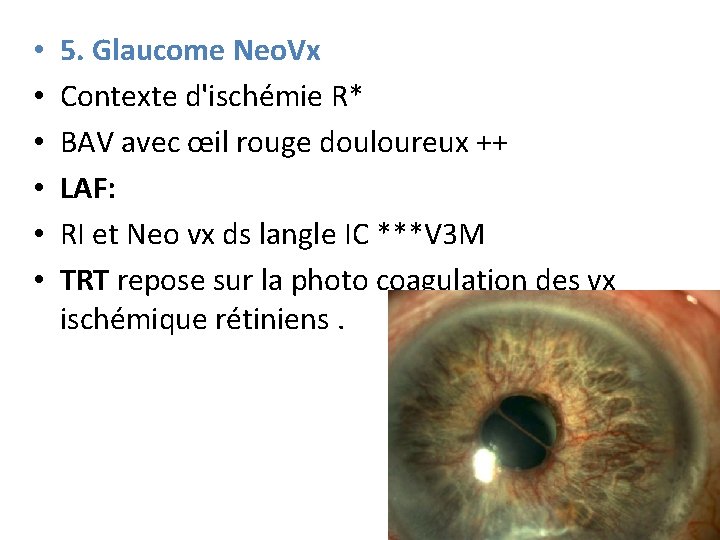  • • • 5. Glaucome Neo. Vx Contexte d'ischémie R* BAV avec œil