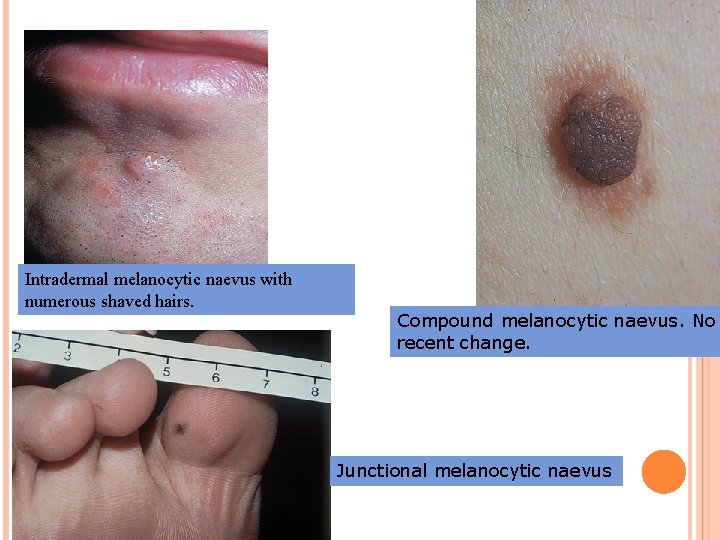 Intradermal melanocytic naevus with numerous shaved hairs. Compound melanocytic naevus. No recent change. Junctional