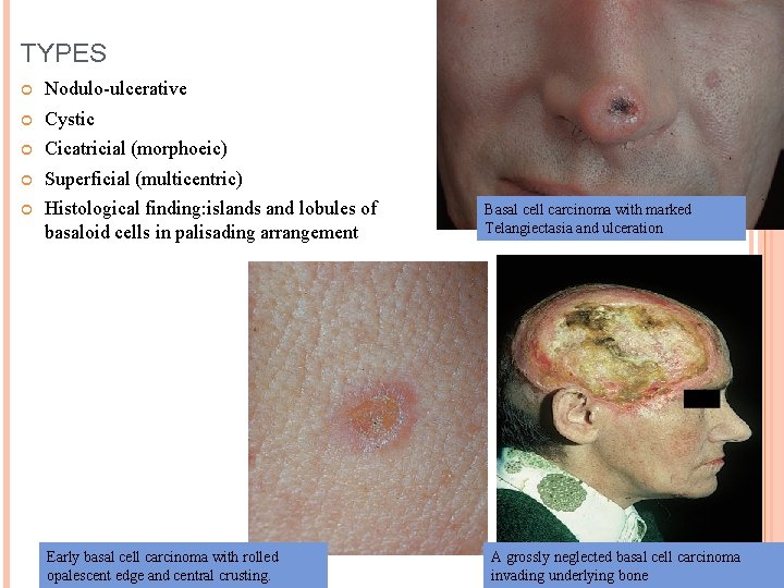 TYPES Nodulo-ulcerative Cystic Cicatricial (morphoeic) Superficial (multicentric) Histological finding: islands and lobules of basaloid